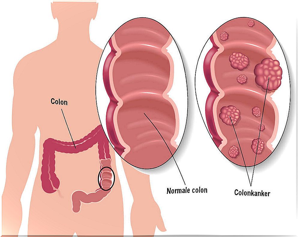 5 tips to help prevent colon cancer