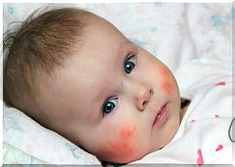 A baby with red cheeks due to eczema