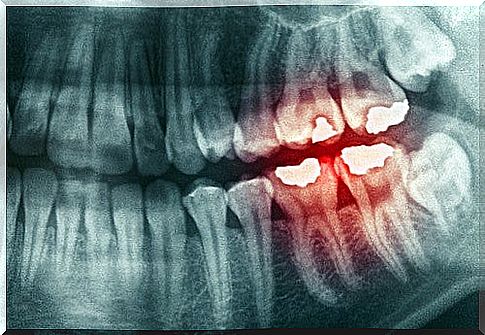 Causes and Effects of Teeth Grinding