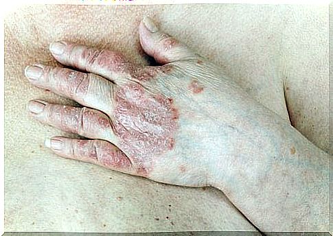 Controlling Psoriasis