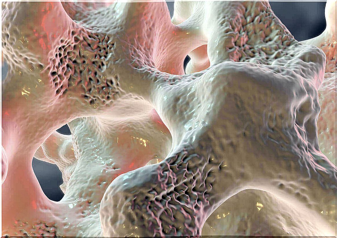 A digital image of bone marrow edema