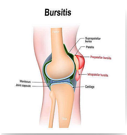 Medical drawing of bursitis