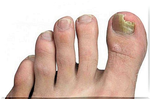 Fungus on your feet?  Read our tips