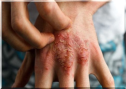 How can you treat psoriasis