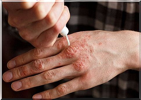 How can you treat psoriasis with topical applications