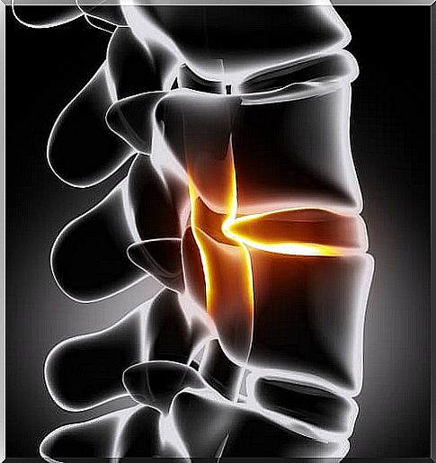 How can you treat sciatica with home remedies?