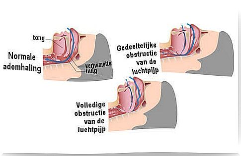 Cause of Snoring