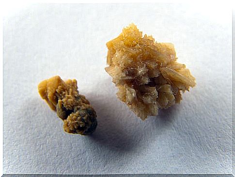 Learn to prevent the formation of kidney stones