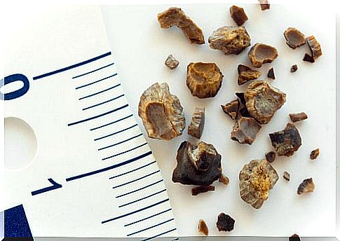 Preventing Kidney Stones