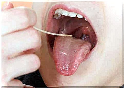 Inflamed tonsils is a symptom of pharyngotonsillitis