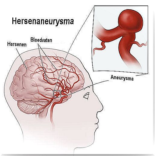 brain aneurysm2