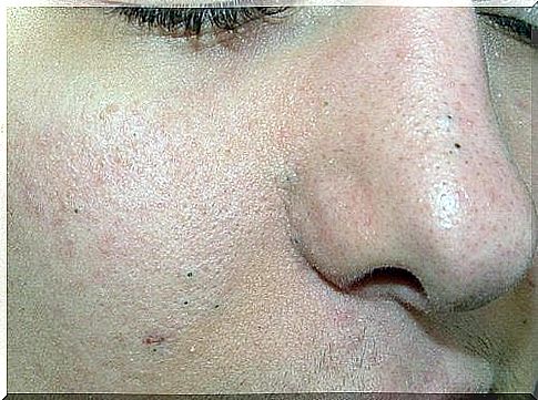 Remove blackheads with 3 homemade exfoliants