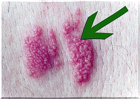 Shingles: what is it and what does it look like?