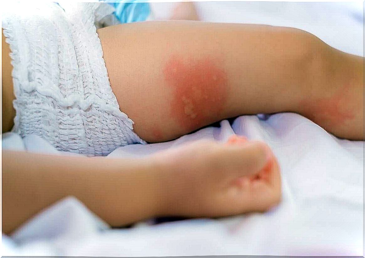 baby with rash