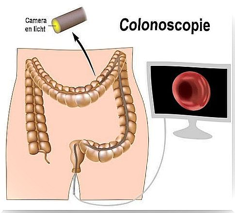 This way you can detect colon cancer in time