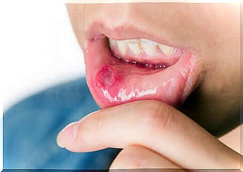 mouth sores