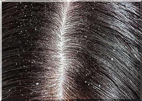 hair with dandruff