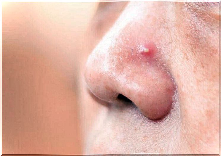 Pimples on your nose