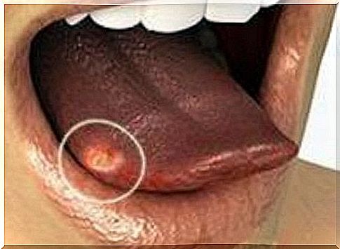 Tongue with sores